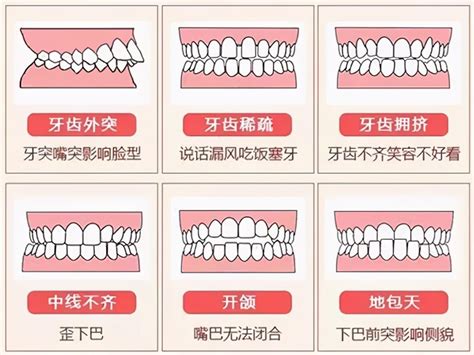 上下排牙齒平行|上下排牙齒貼到實 竟然不是正常的咬合？(上) 